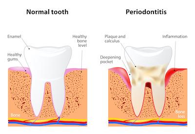 healthy gums compared to unhealthy gums