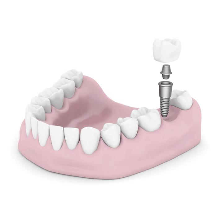 illustration of dental implant