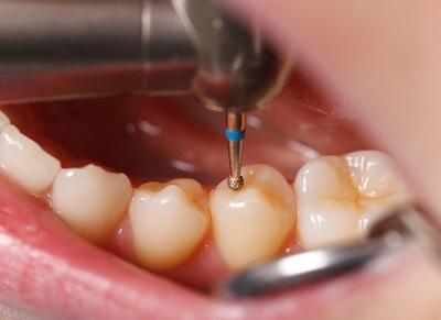 close up of dental filling