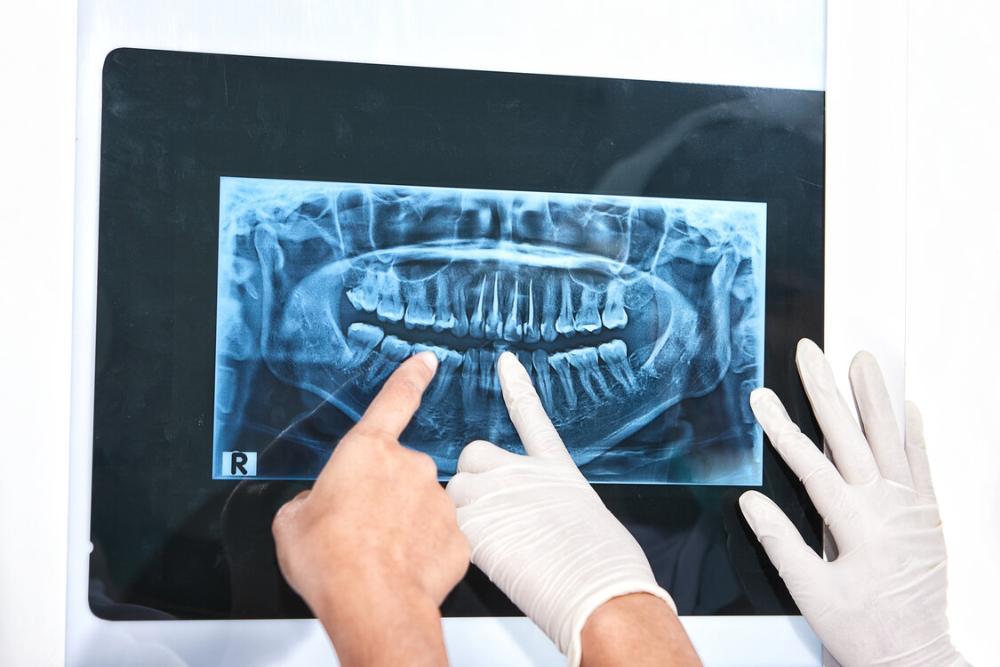 dental xray in balaga dental clinic