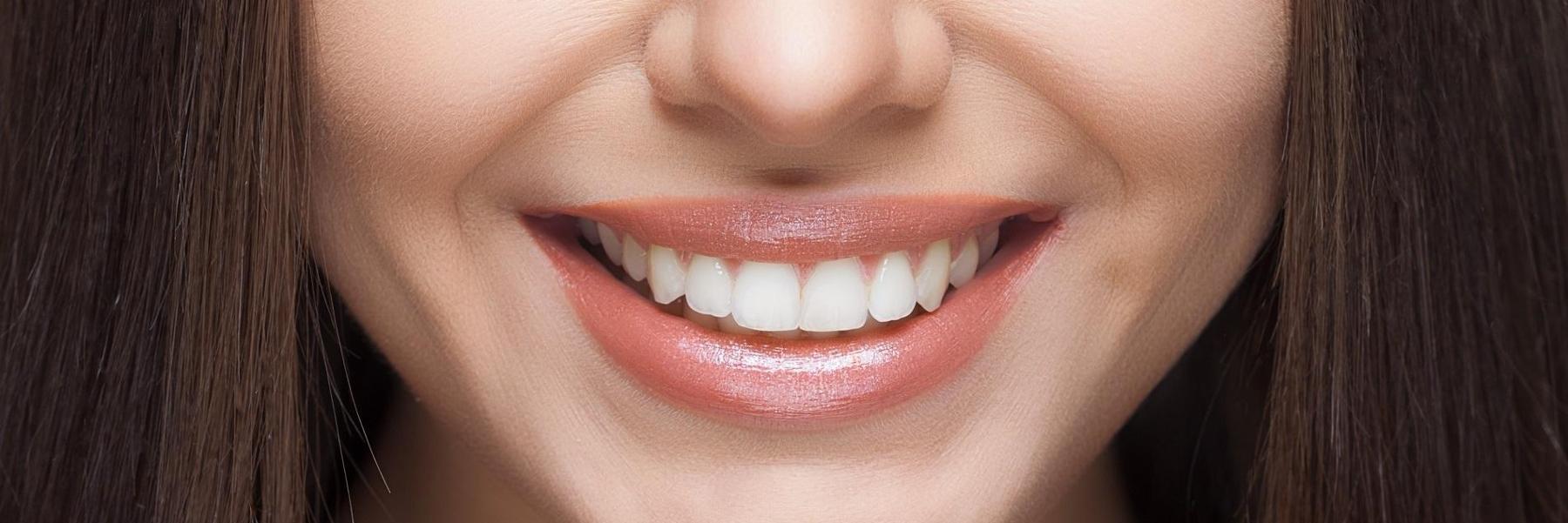 close up of woman's smile after teeth whitening